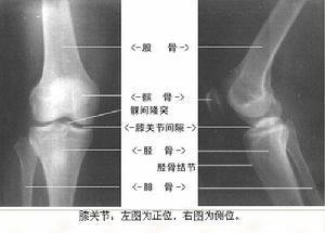 膝眼穴:在髌韧带两侧凹陷处;内侧的称内膝眼,外侧的称外膝眼.