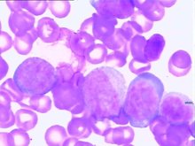 原发性中枢神经系统血管炎