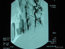 颅内肉芽肿性动脉炎