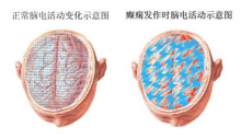 癫痫