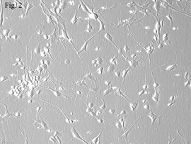 先天性小脑颗粒细胞发育不全