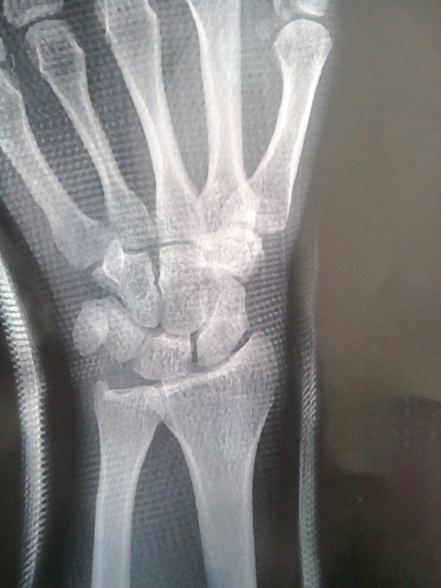 骨科大夫看看周壮骨折,恢复的如何了。一周了